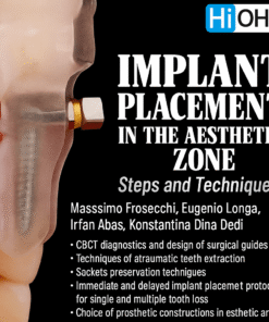 Implant Placement in the Aesthetic Zone: Steps and Technique