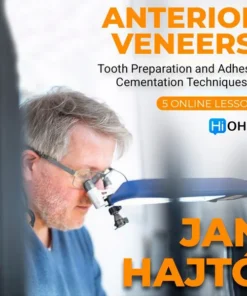 Anterior Veneer: Tooth Preparation and Adhesive Cementation Techniques