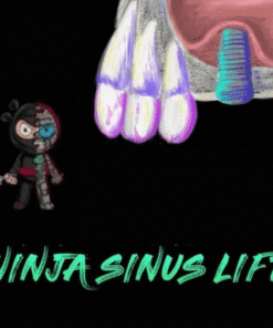 Ninja Sinus Lift Course