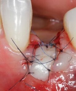 Soft Tissue Management around Natural Teeth and Dental Implants: Fundamentals, Evidence Based and Surgical Innovations