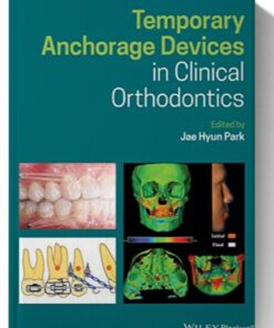 Temporary Anchorage Devices in Clinical Orthodontics 1st Edition